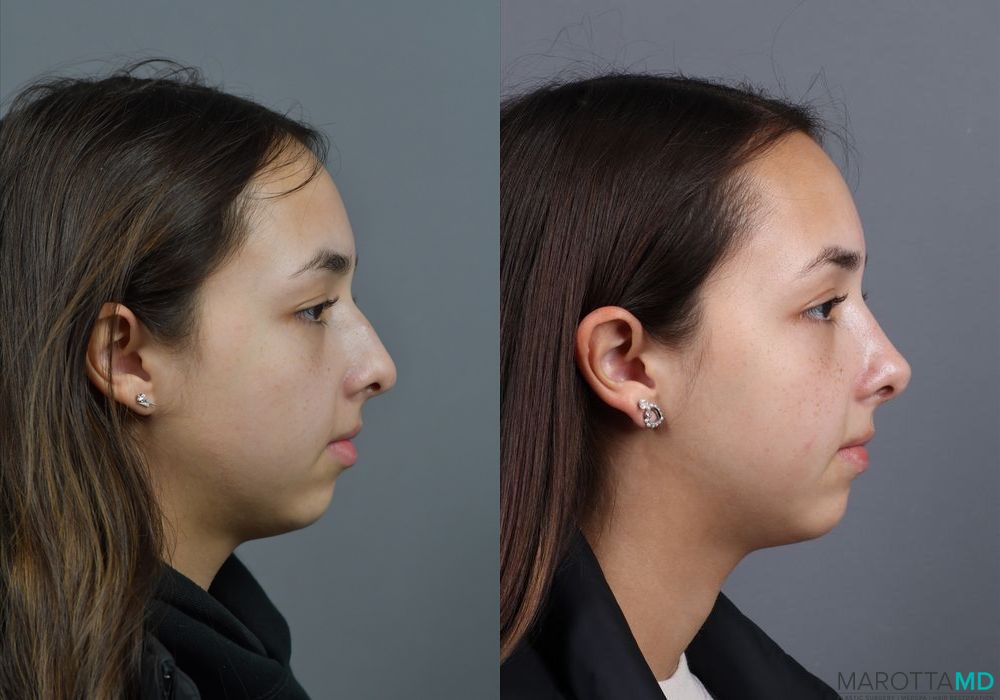 Before and after Rhinoplasty case 7279 - Angle 5