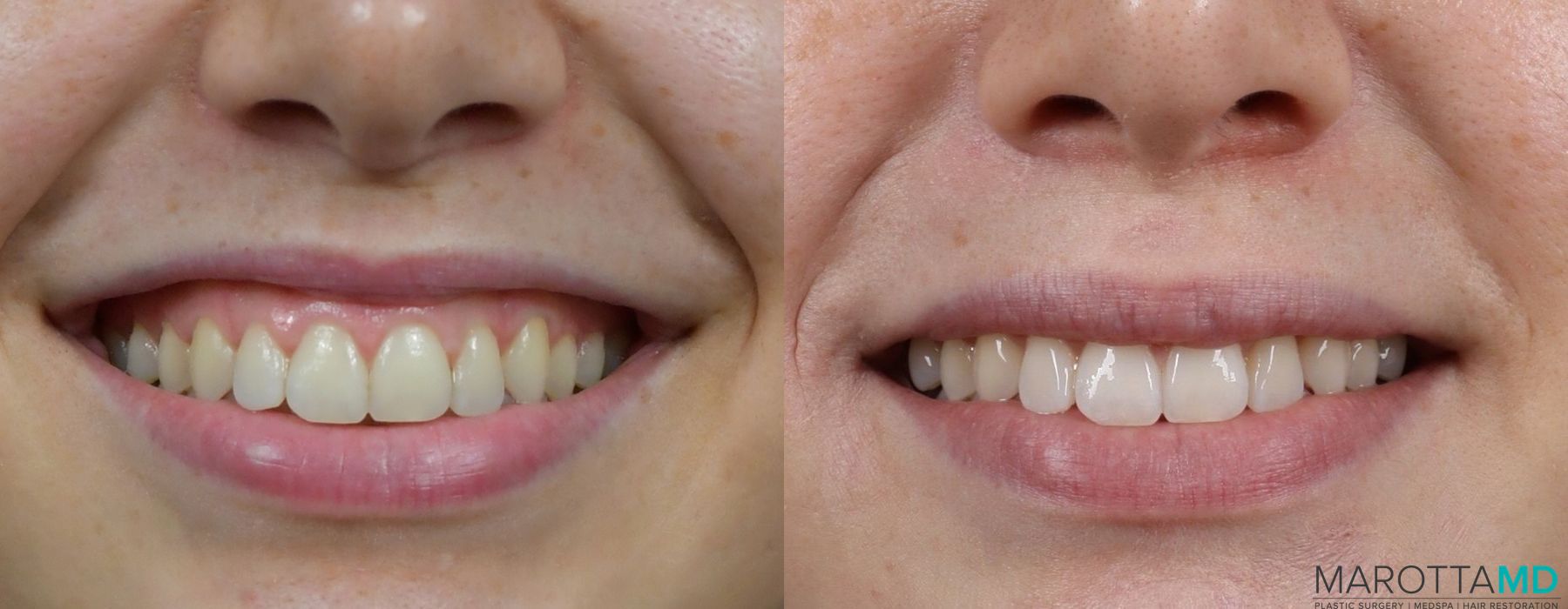 Before and after Botox - Lip Flip case 7202 - Angle 2