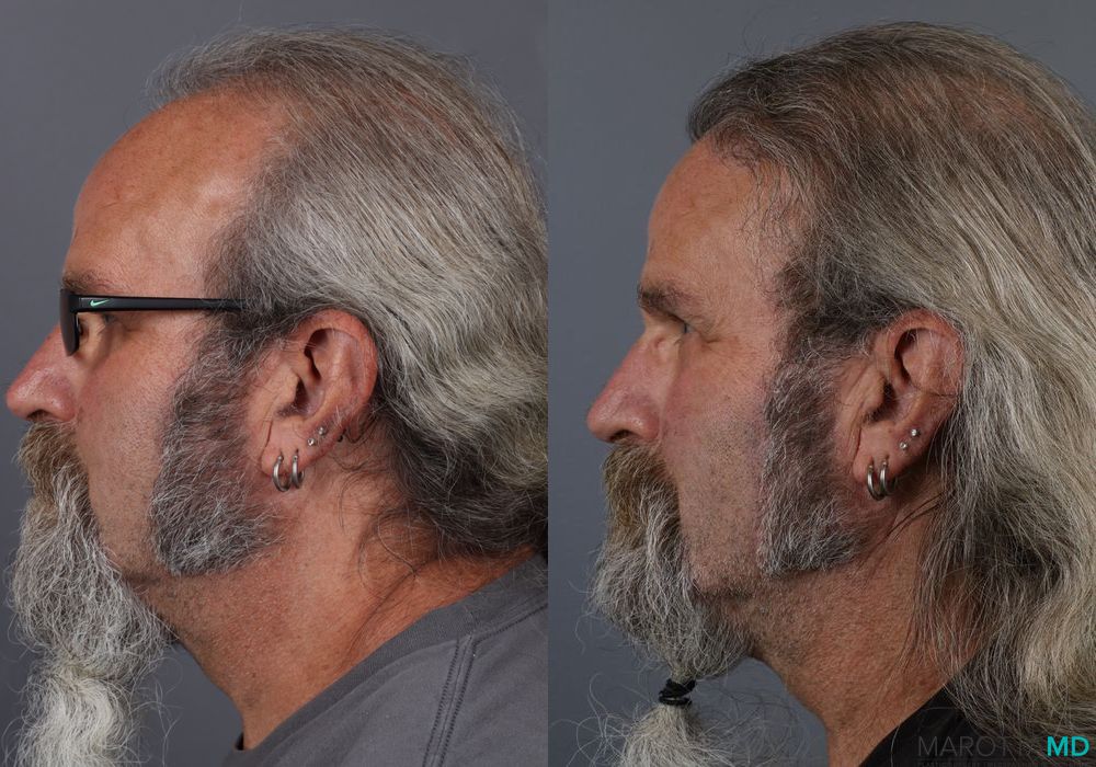 Hair Transplantation - Thumbnail 4