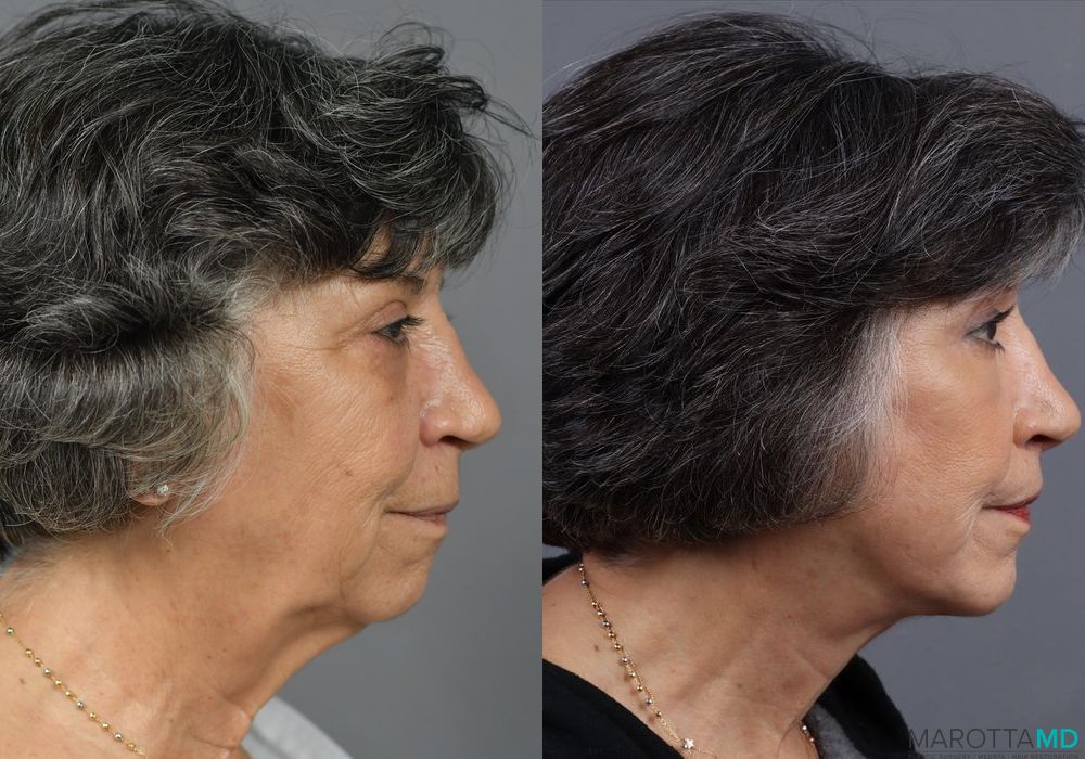 Before and after Lip Lift case 7038 - Angle 3