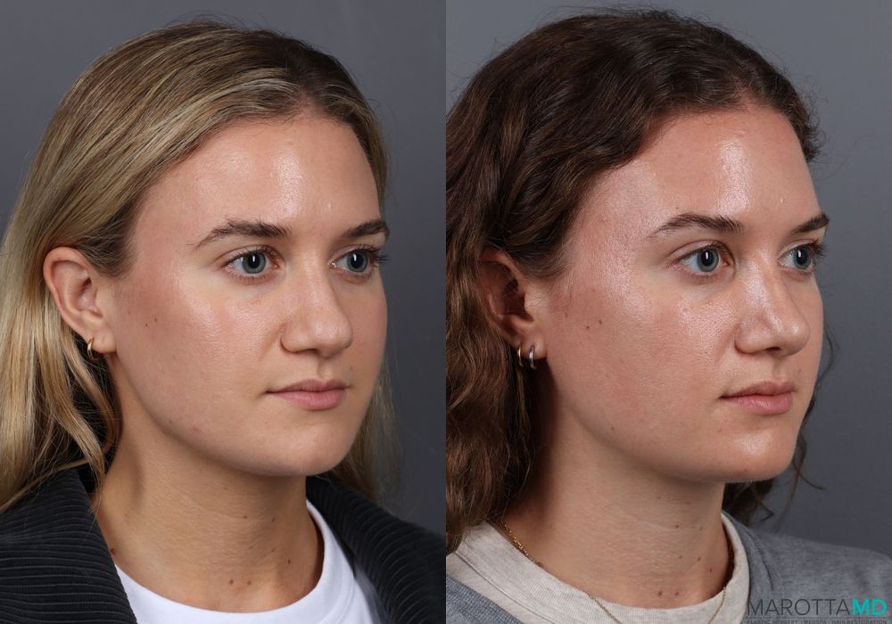 Rhinoplasty - Thumbnail 2