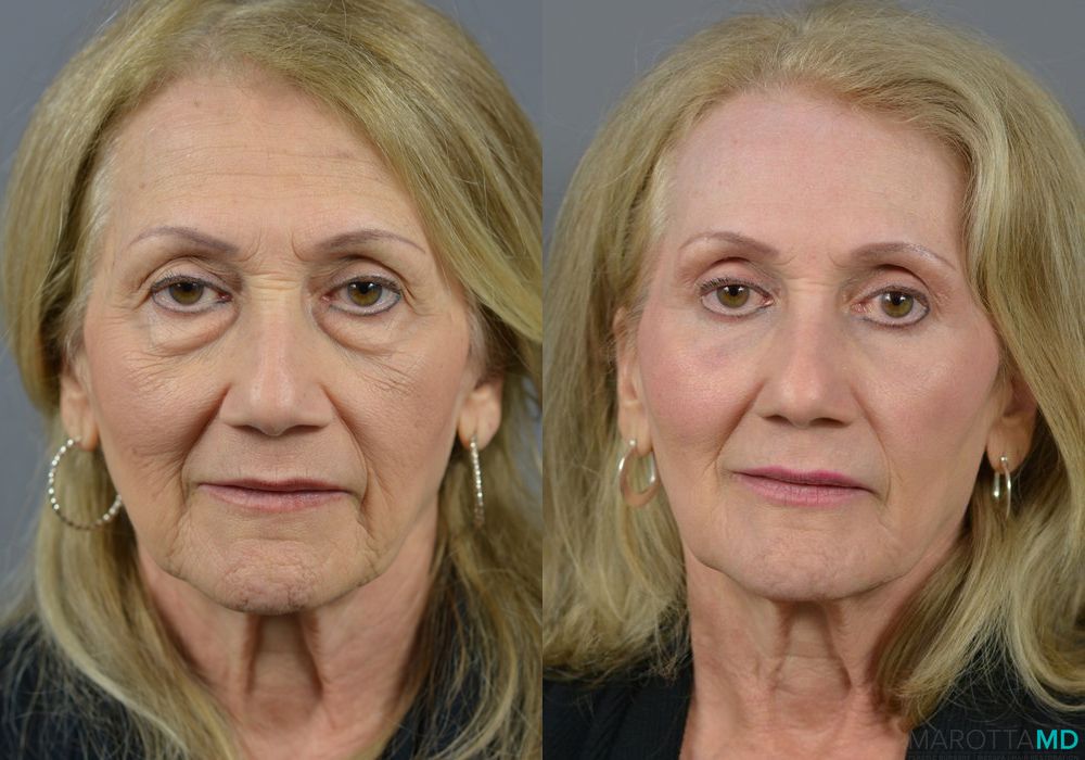 Laser Skin Resurfacing - Face - Thumbnail 2