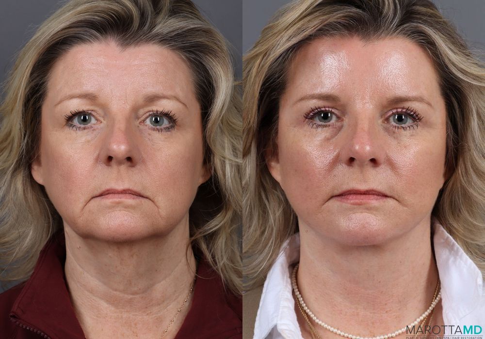 Before and after Facelift & Neck Lift case 7056