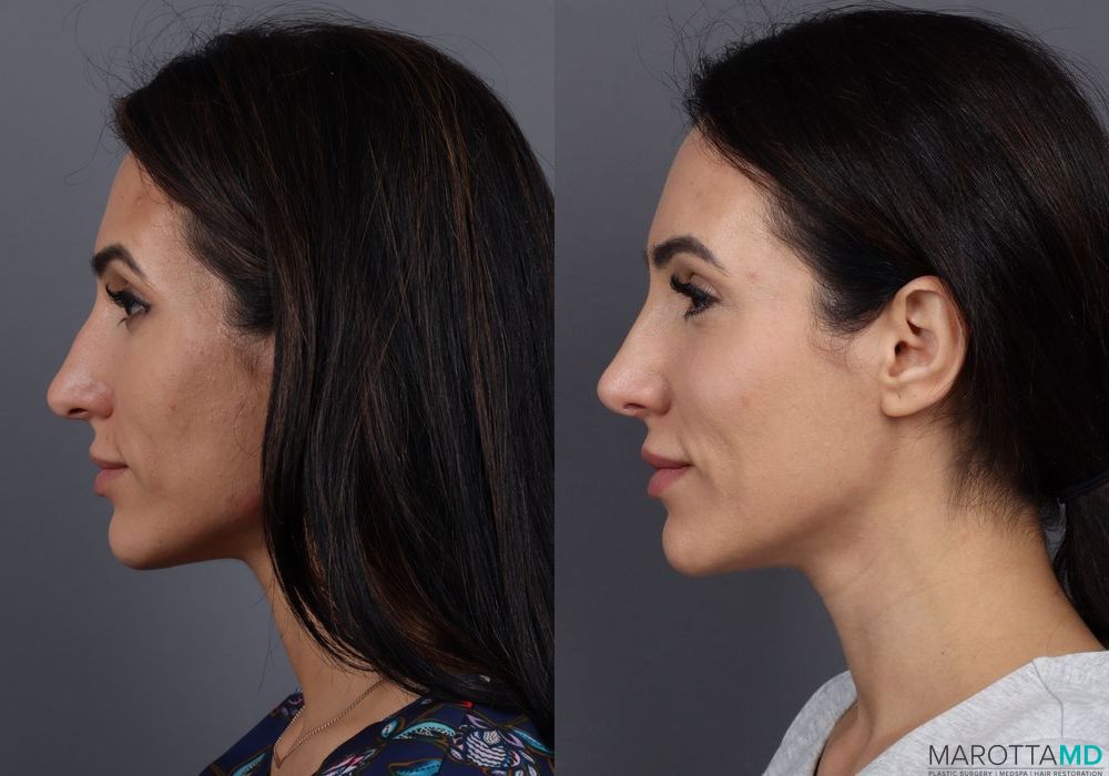 BOTOX® Cosmetic - Thumbnail 3