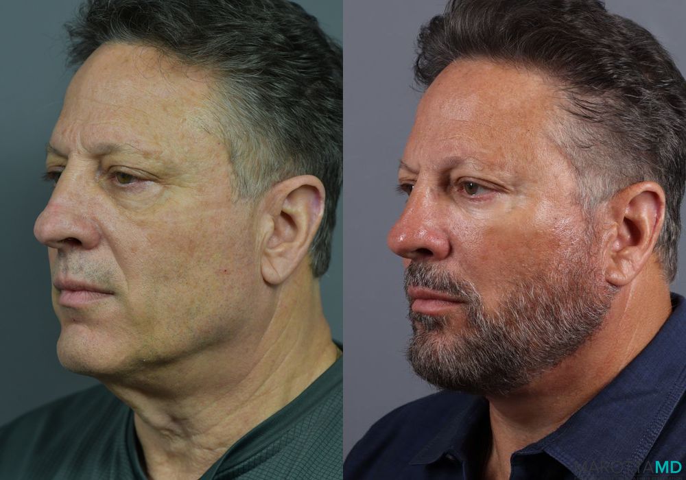 Facelift & Neck Lift - Thumbnail 2