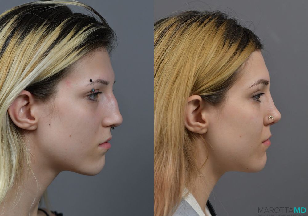 Before and after Rhinoplasty case 7257 - Angle 3