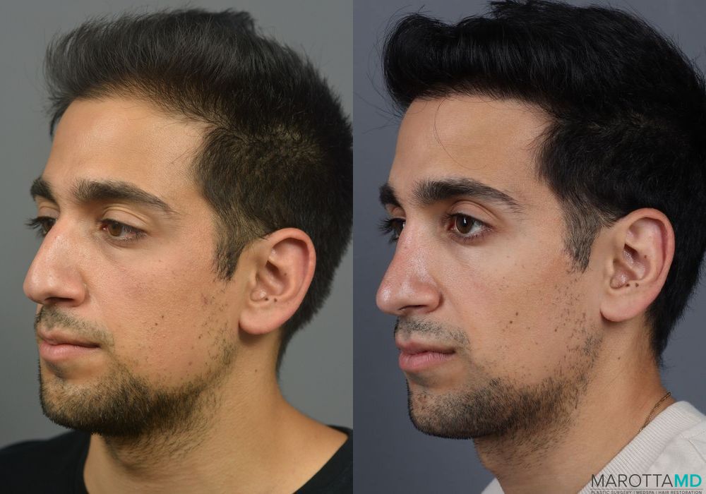 Before and after PRP Scalp Treatment case 7199 - Angle 3