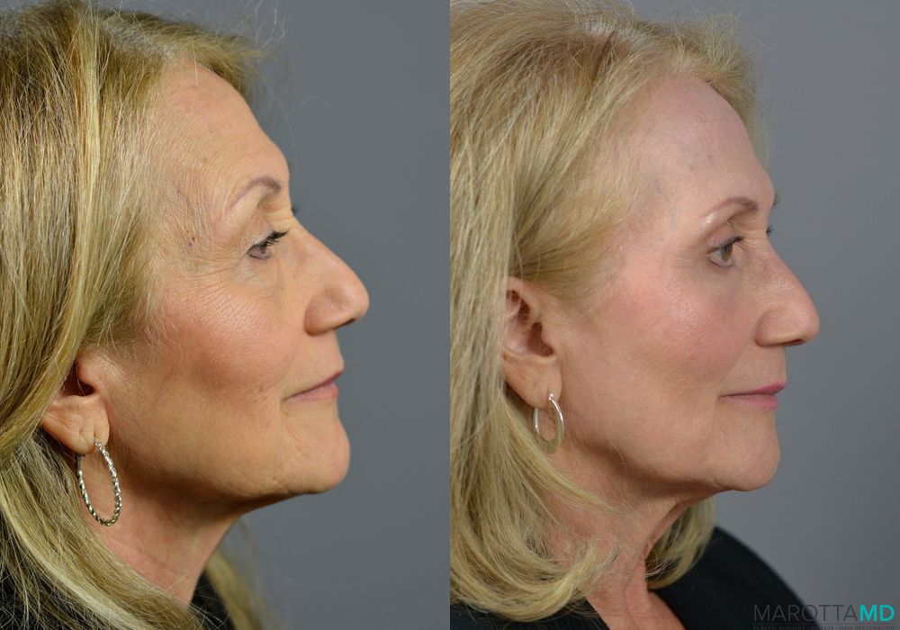 Laser Skin Resurfacing - Face - Case 213