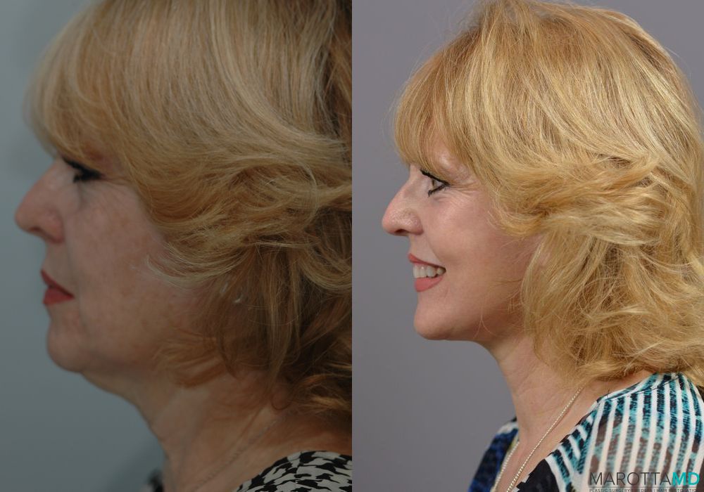 Laser Skin Resurfacing - Face - Thumbnail 5