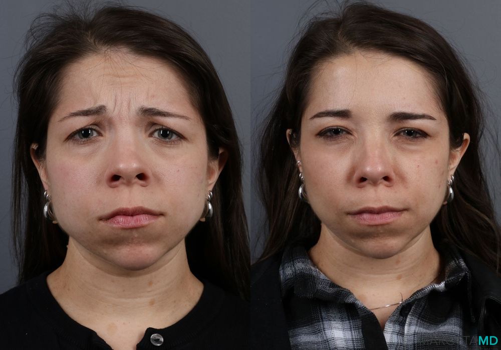 Botox - Forehead - Thumbnail 3