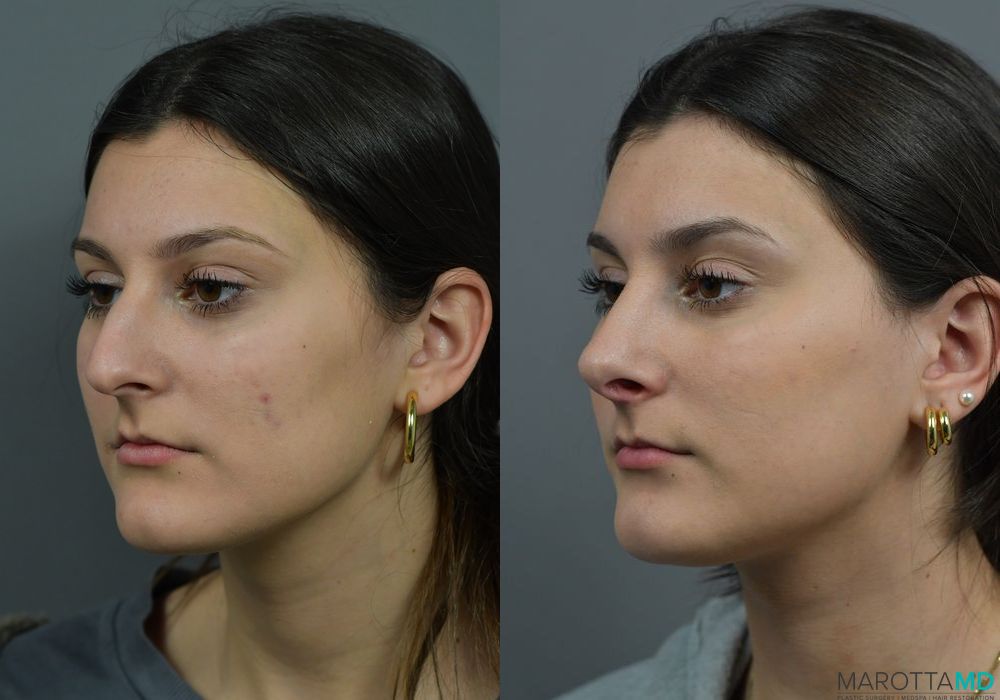 Before and after Rhinoplasty case 7283 - Angle 4
