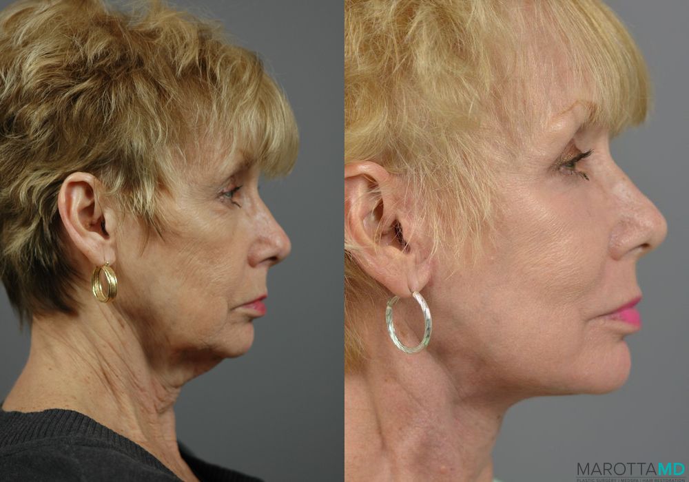 Facelift & Neck Lift - Thumbnail 2
