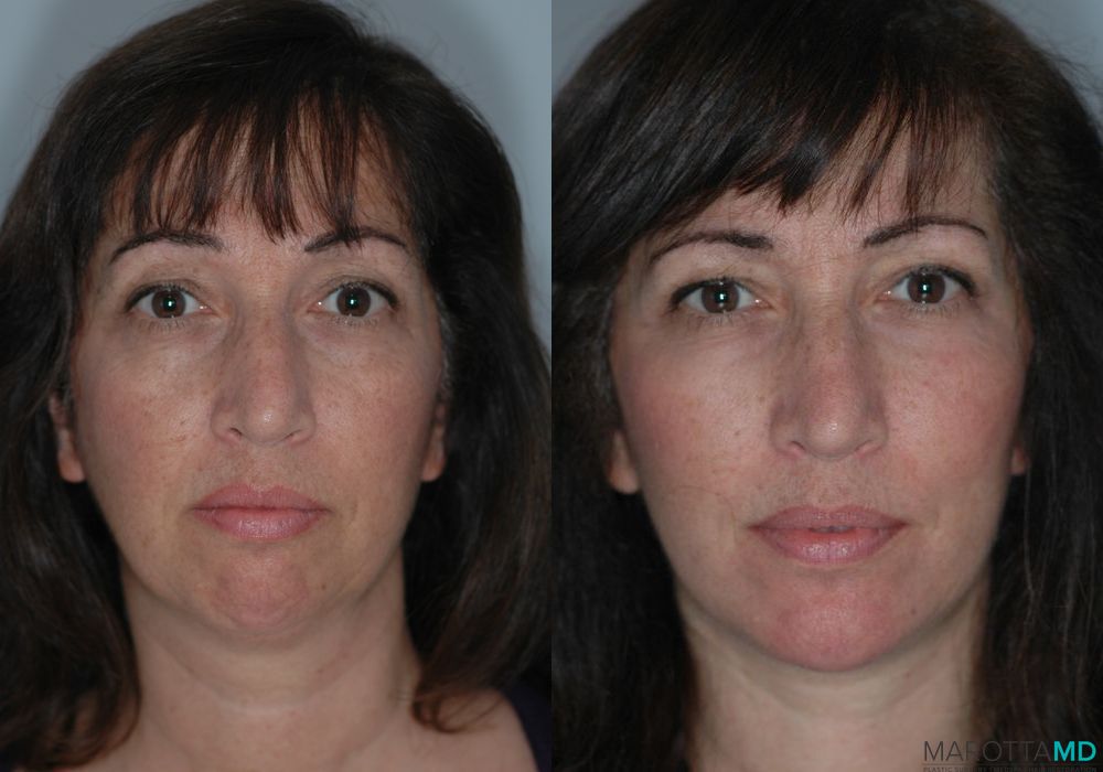 Liposuction of the Neck - Case 228