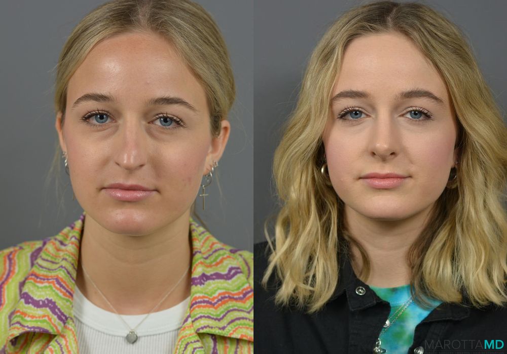 Rhinoplasty - Thumbnail 4