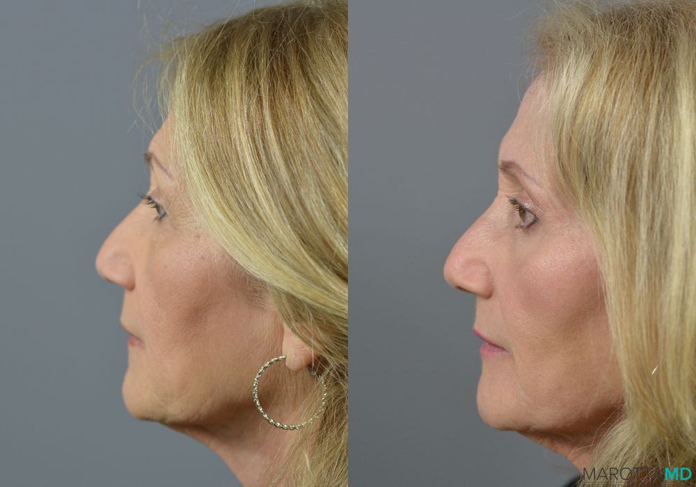 Laser Skin Resurfacing - Face - Thumbnail 3
