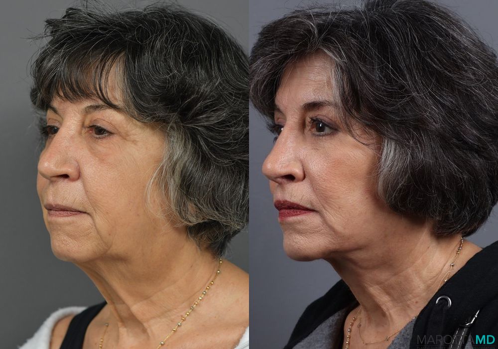 Before and after Lip Lift case 7038 - Angle 4