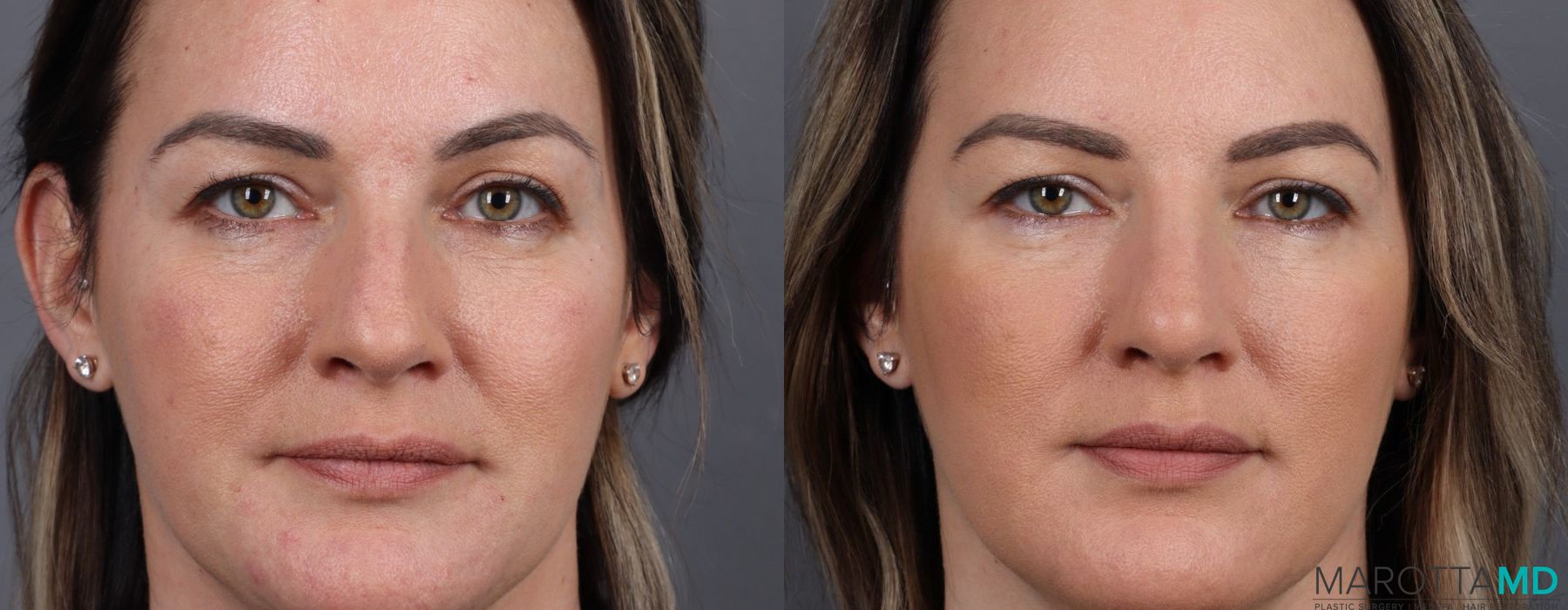 Non-Surgical Rhinoplasty - Thumbnail 3