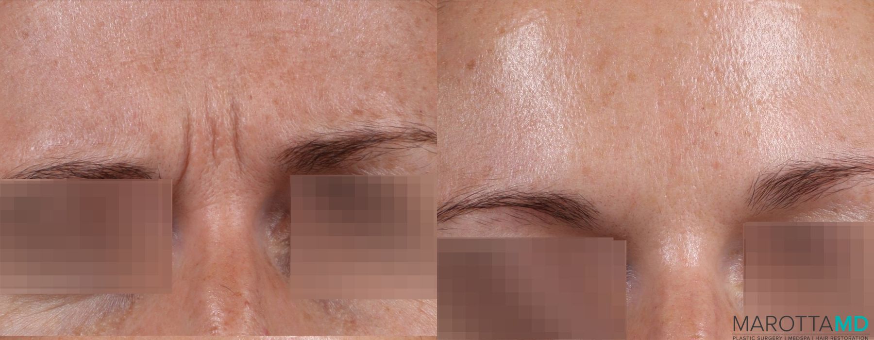 Before and after Botox - Chin case 7195