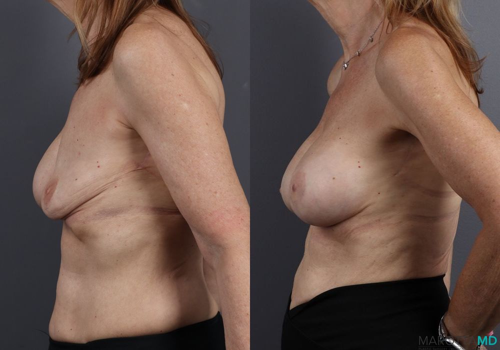 Before and after Breast Implant Exchange case 7245 - Angle 5