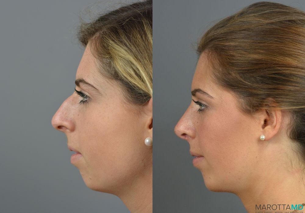 Rhinoplasty - Thumbnail 2