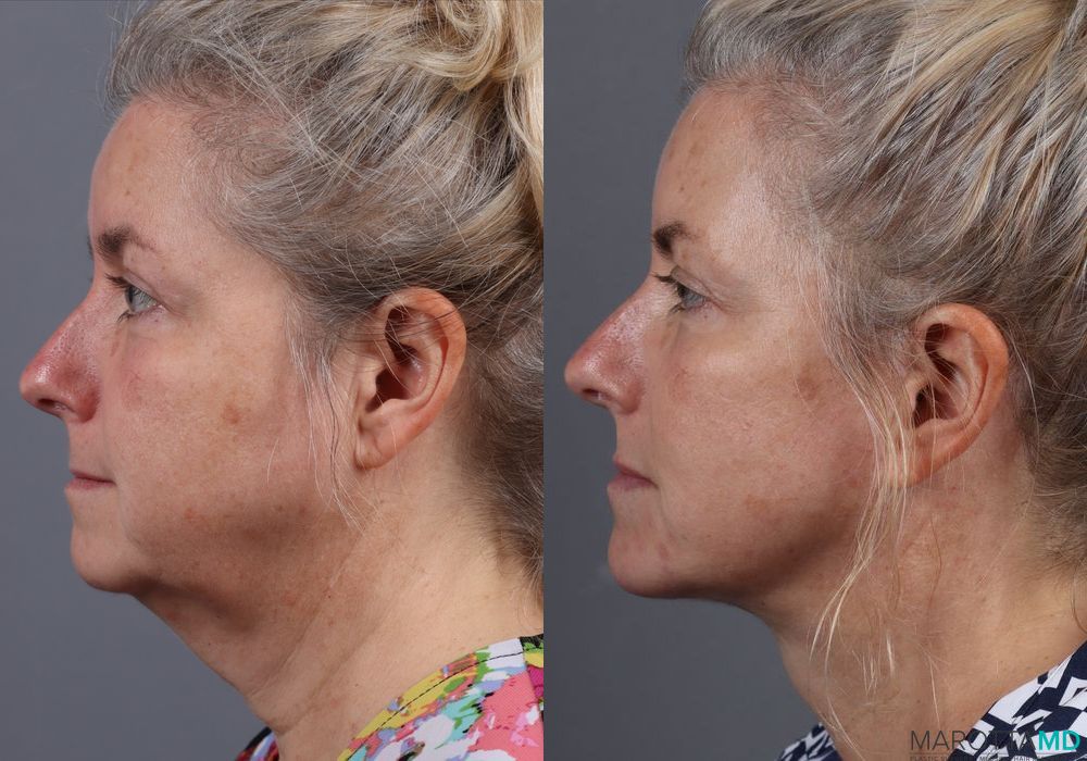 Facelift & Neck Lift - Case 192