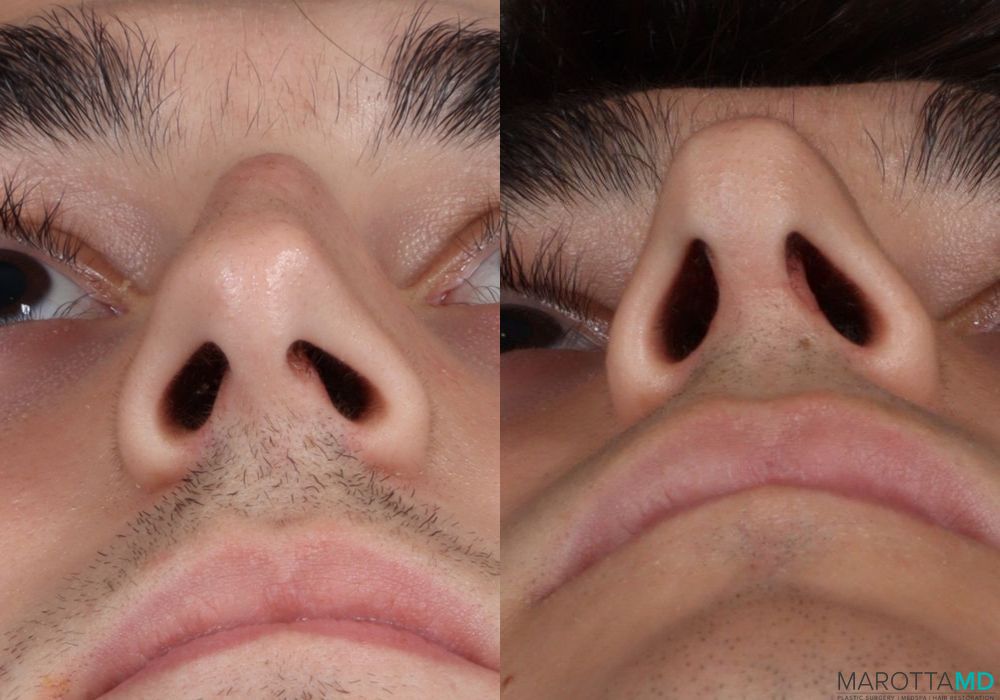 Before and after Male Rhinopolasty case 7015 - Angle 6