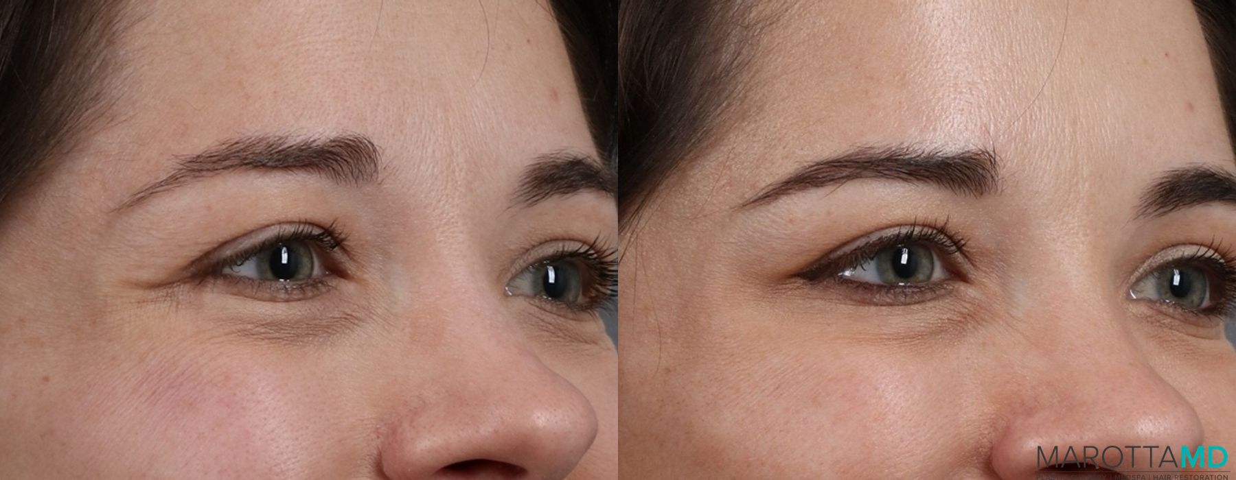 Botox - Crow's Feet - Thumbnail 4