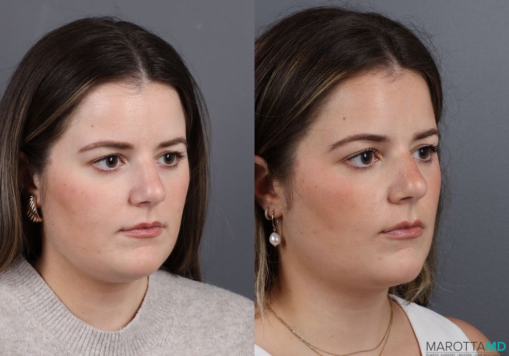 Before and after Liposuction of the Neck case 7011 - Angle 2