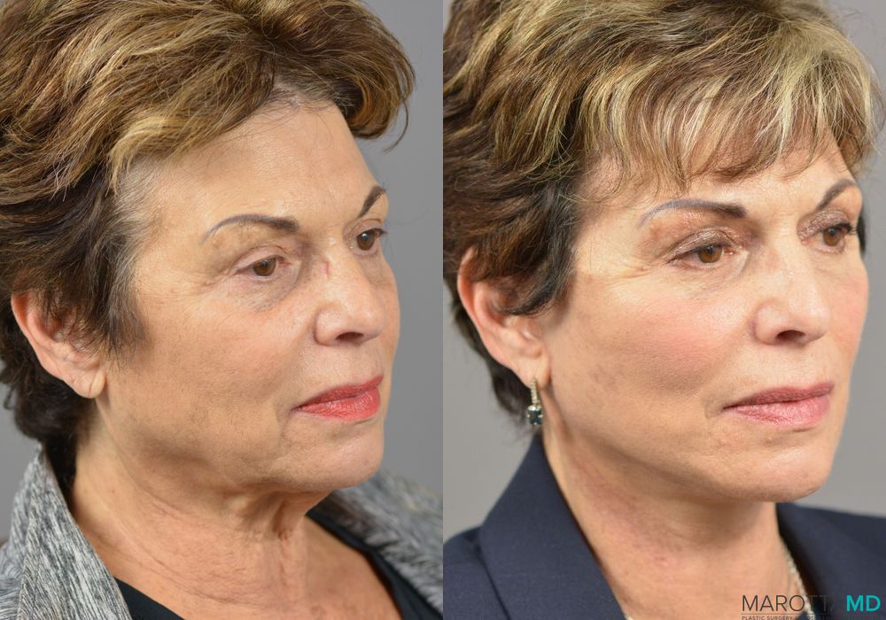 Before and after Facelift & Neck Lift case 7023 - Angle 4