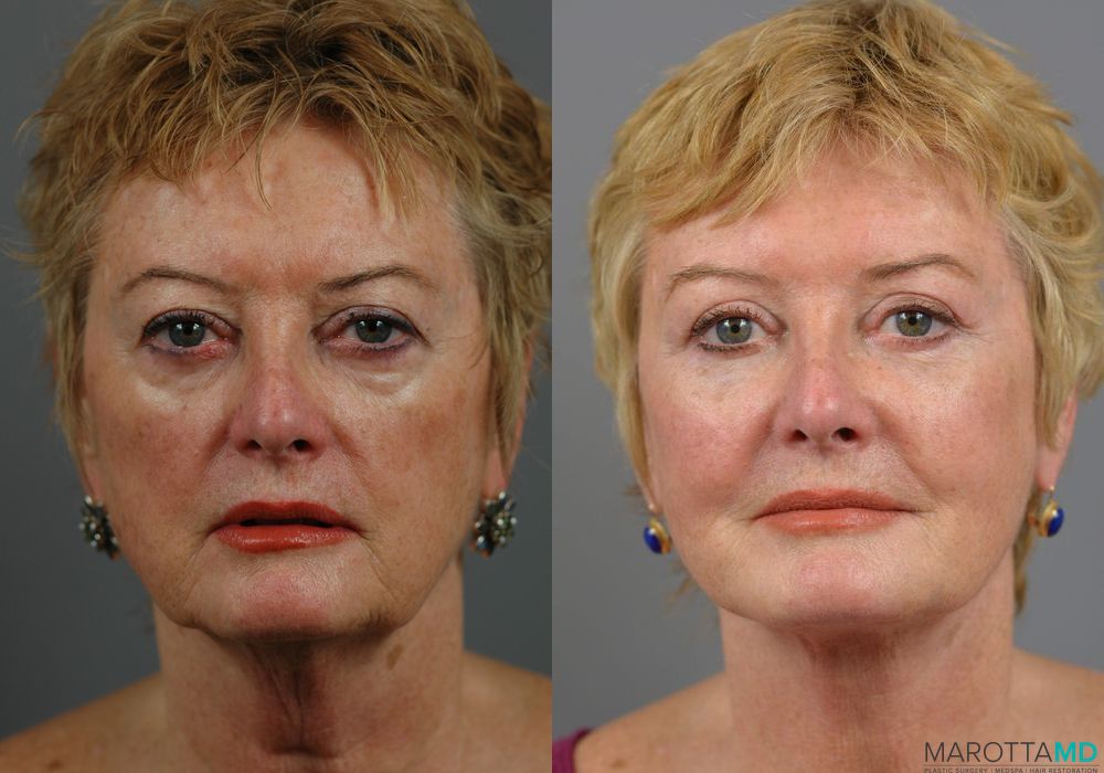 Blepharoplasty - Thumbnail 3