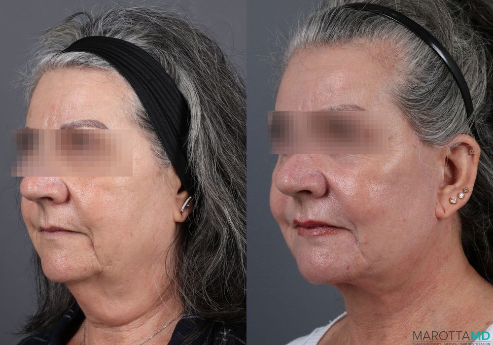 Laser Skin Resurfacing - Face - Case 217