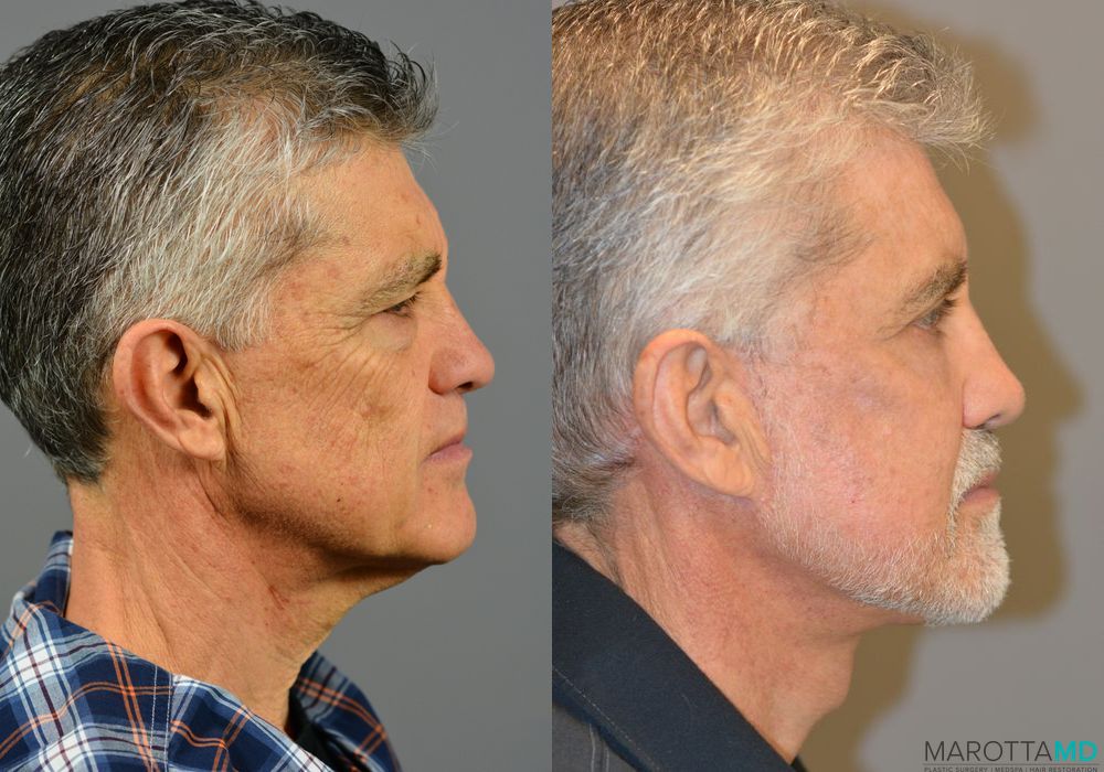 Facelift & Neck Lift - Thumbnail 5