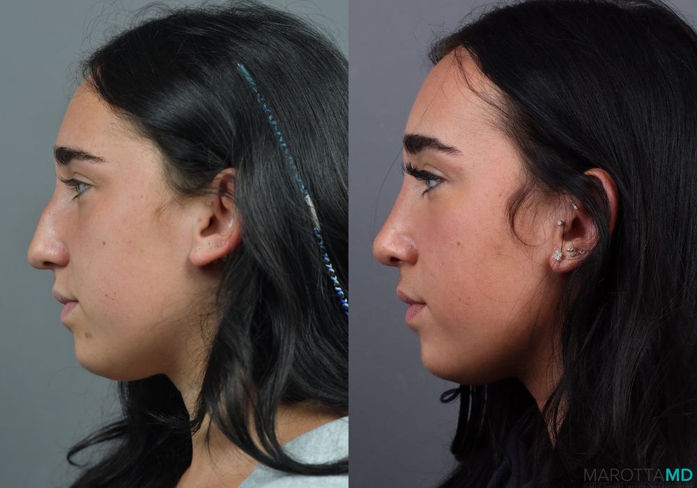 Before and after Rhinoplasty case 7286 - Angle 5