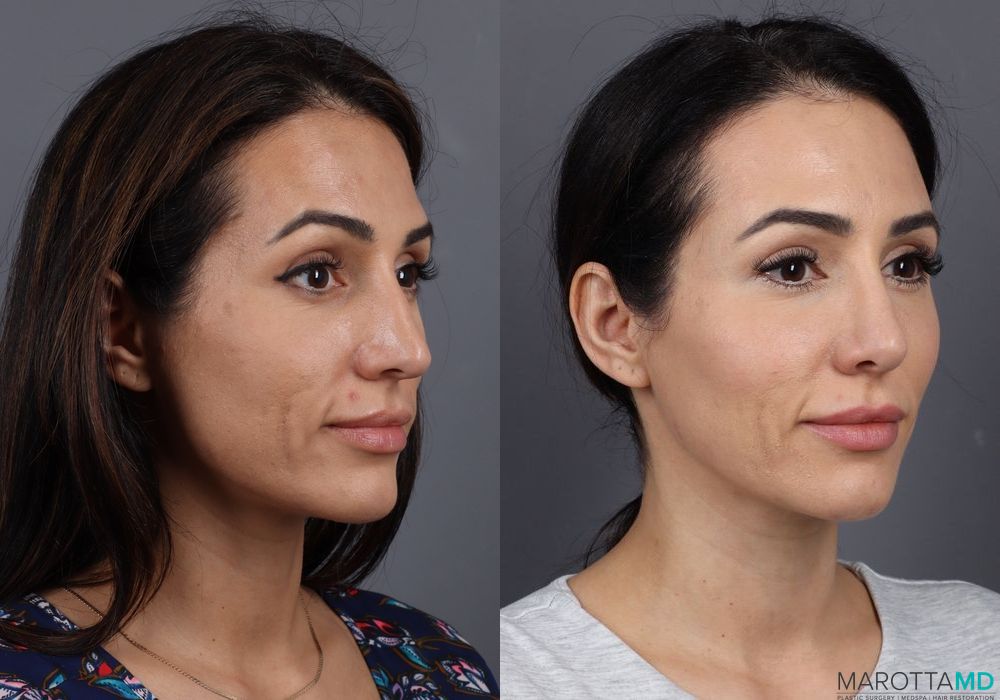 Rhinoplasty - Thumbnail 4