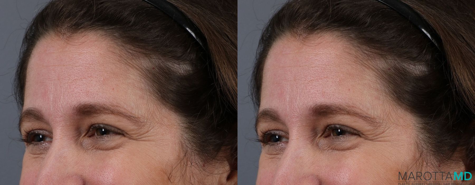 Before and after Botox - Crow's Feet case 7167 - Angle 4