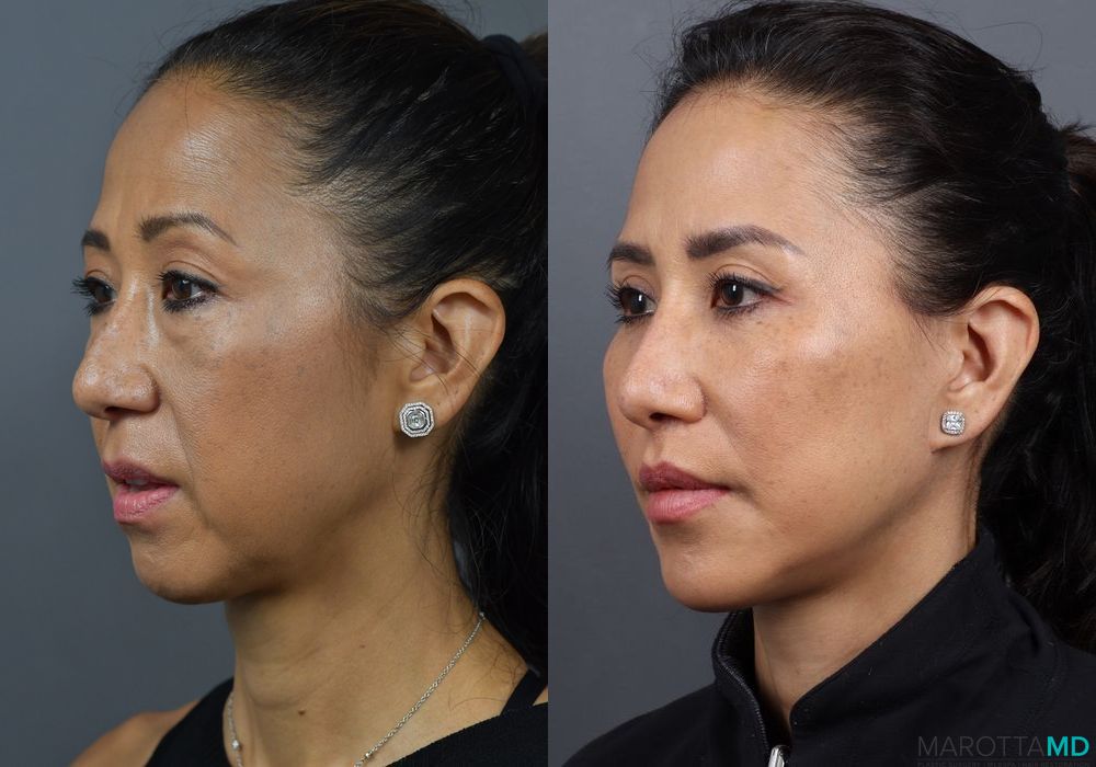 Chin Implant - Thumbnail 3