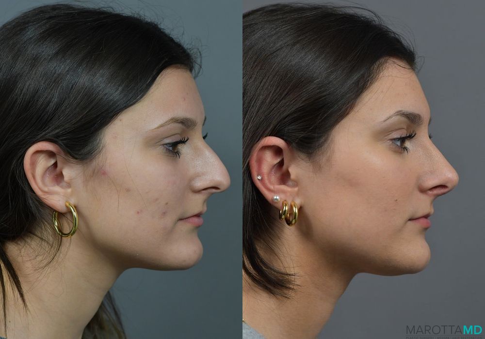 Before and after Rhinoplasty case 7283 - Angle 3