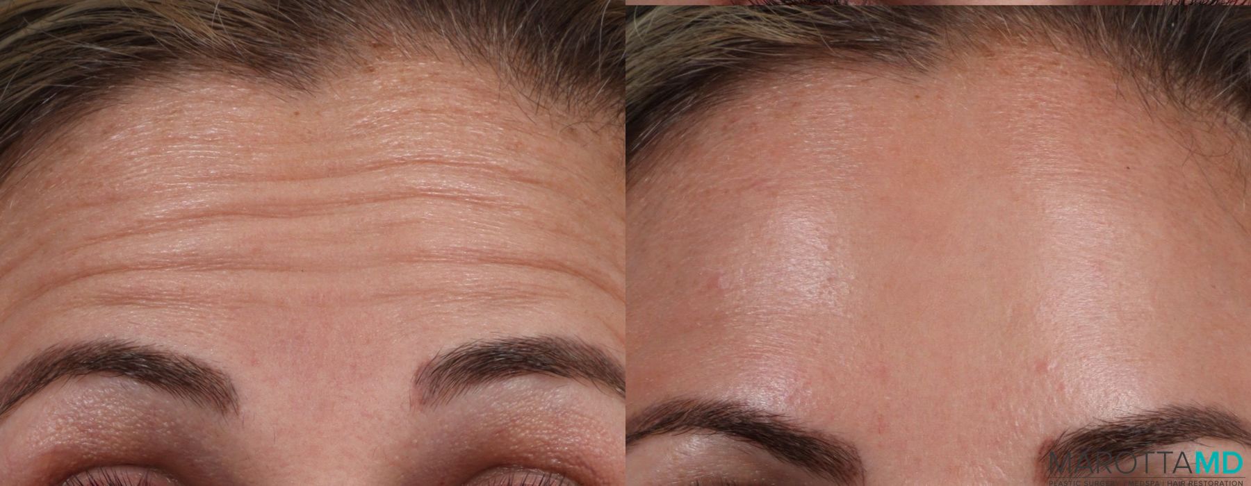 Before and after BOTOX® Cosmetic case 7304