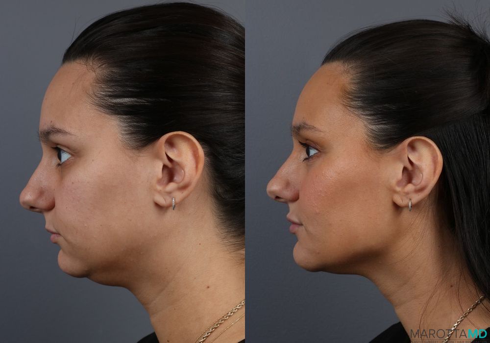 Before and after Filler - Lips case 7210 - Angle 5