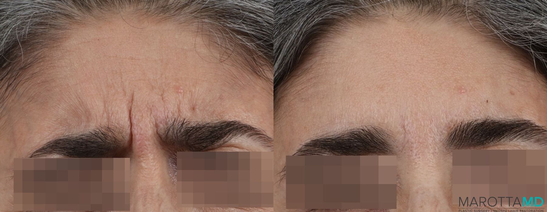 Before and after Botox - Chin case 7155