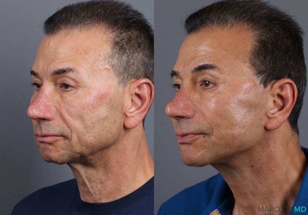 Before and after Facelift & Neck Lift case 7115 - Angle 4