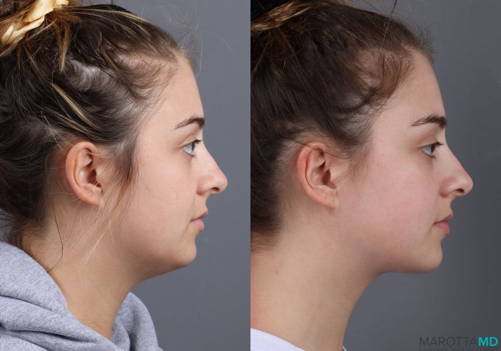 Liposuction of the Neck - Thumbnail 3