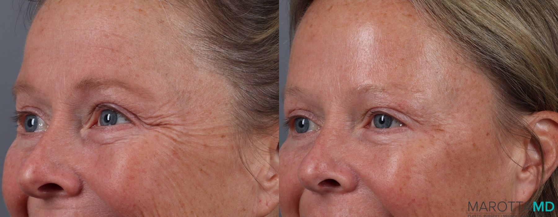 Before and after Botox - Crow's Feet case 7131