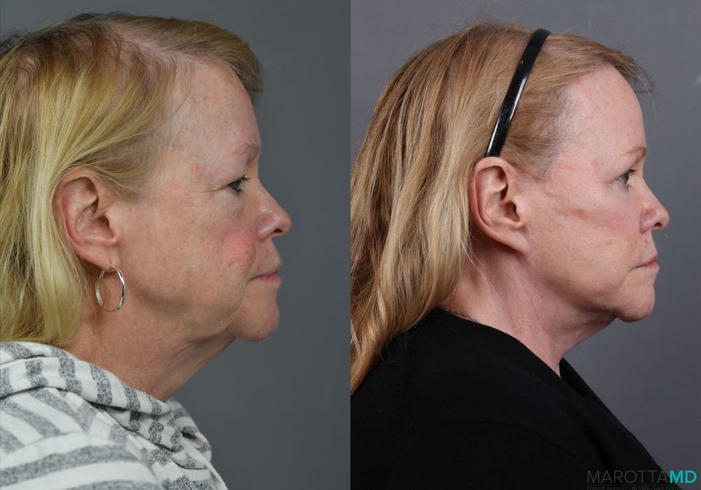 Blepharoplasty - Thumbnail 4