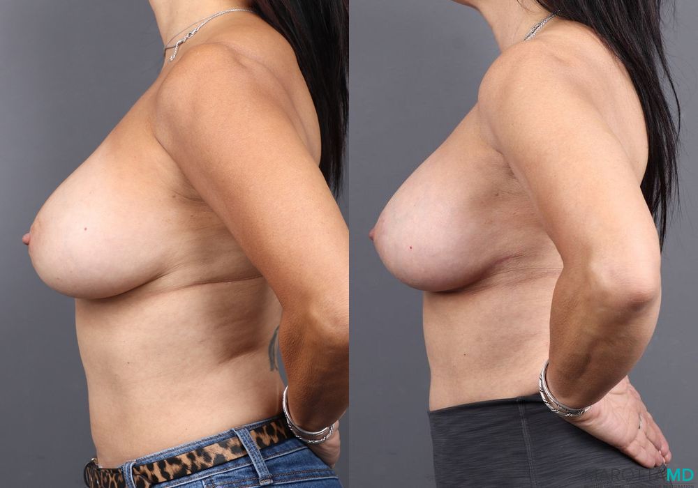 Breast Lift - Thumbnail 5