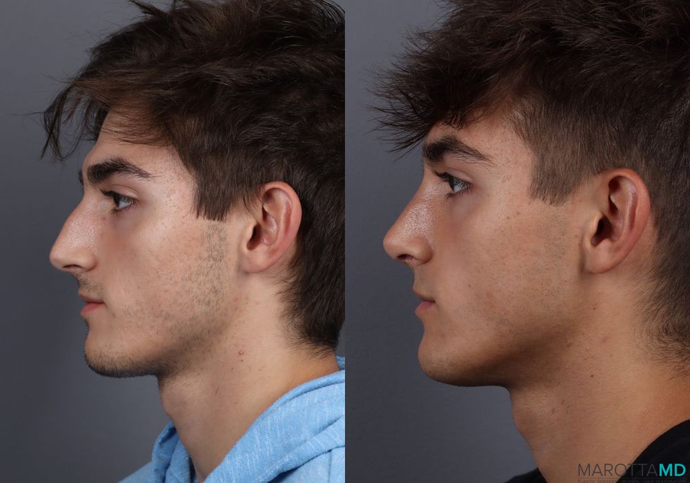 Before and after Male Rhinopolasty case 7015 - Angle 2