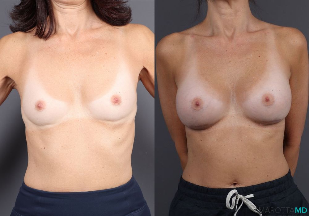 Breast Augmentation - Case 132