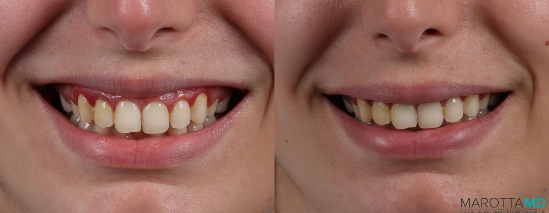 Before and after BOTOX® Cosmetic case 7248
