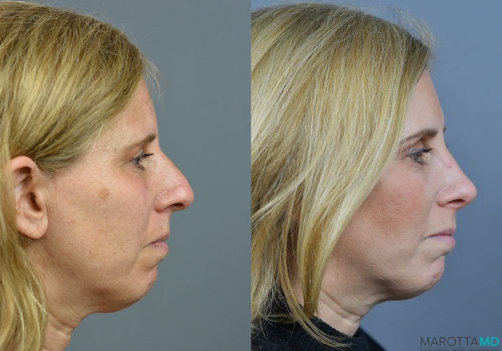 Before and after Rhinoplasty case 7203 - Angle 3