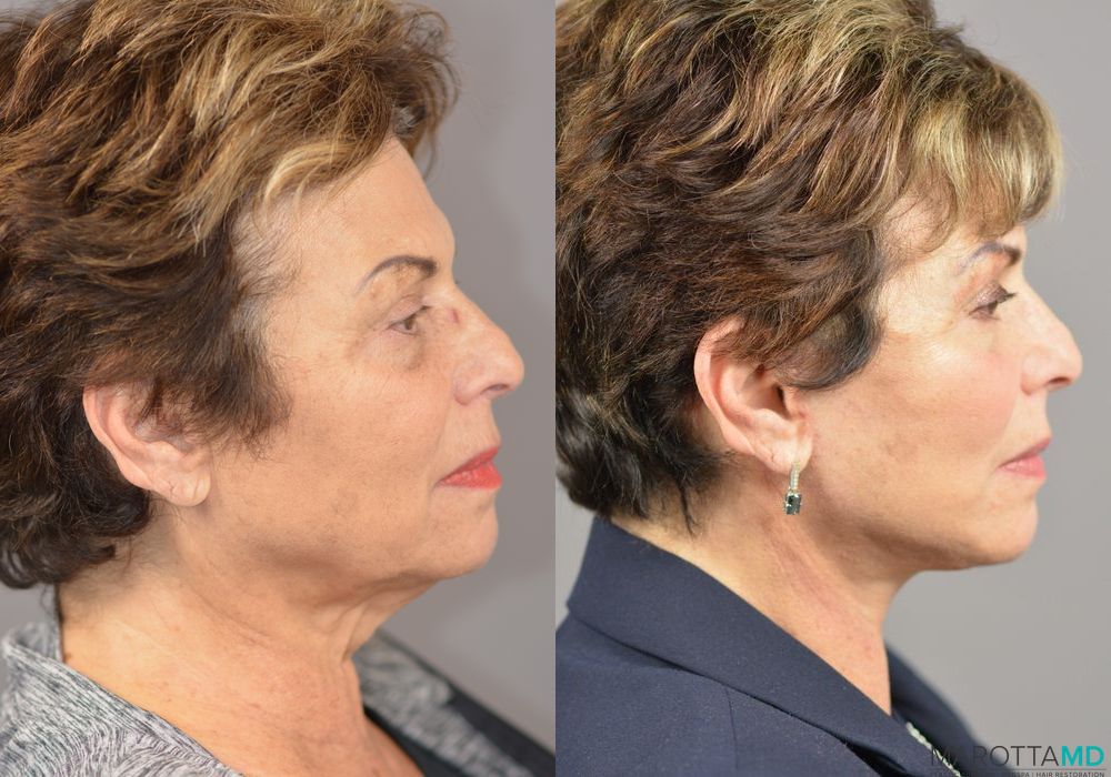 Before and after Facelift & Neck Lift case 7023 - Angle 3